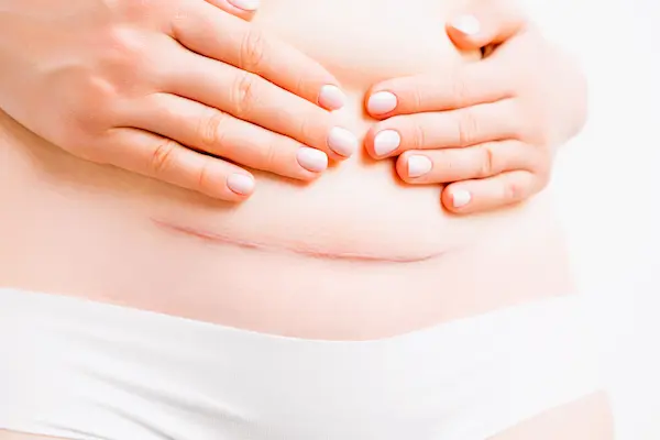 Cicatriz abdominal de cesárea con manos sobre el vientre, asociada a negligencia médica tras cirugía.